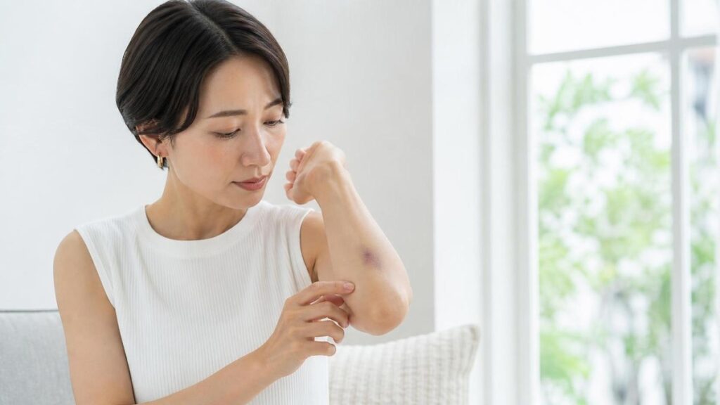 紫のあざ 治し方｜内出血のケアと早く相談すべき症状
